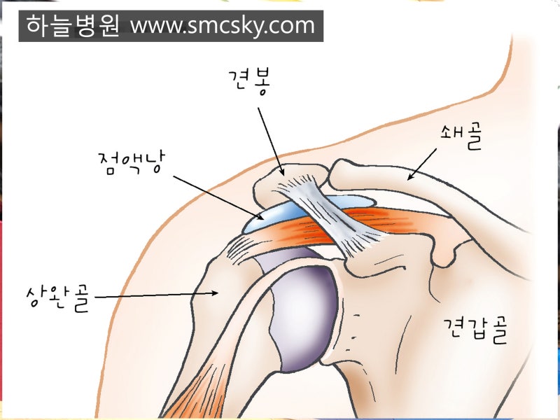 어깨 석회성건염 어깨통증 증상 및 치료, 갑자기 극심한 어깨 아플때