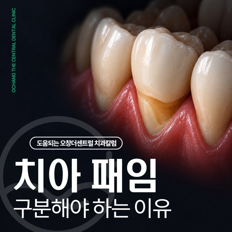 굴곡파절과 치경부 마모증을 구분해야 하는 이유