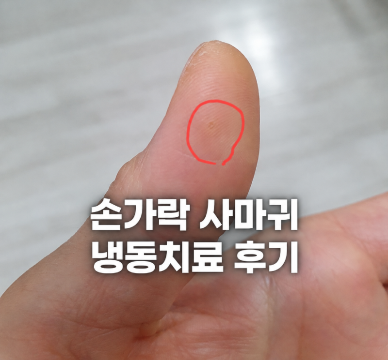 엄지손가락 사마귀 냉동치료 후기｜생각보다 아팠던 치료 과정과 회복 과정