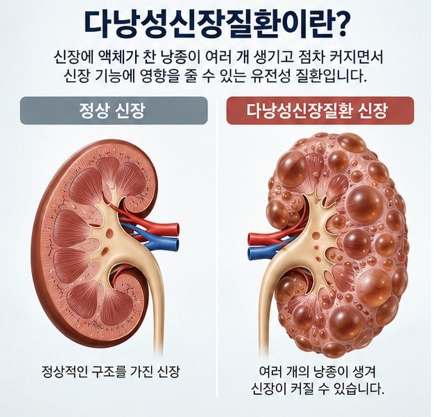 다낭성신장질환 증상, 원인, 유전, 검사, 치료, 신장 물혹이 많다면 꼭 알아야 할 내용 등 총....
