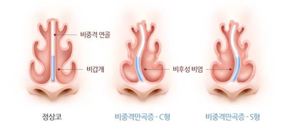 비중격만곡증 수술비용, 당일 입원인지 며칠인지 실제 일정