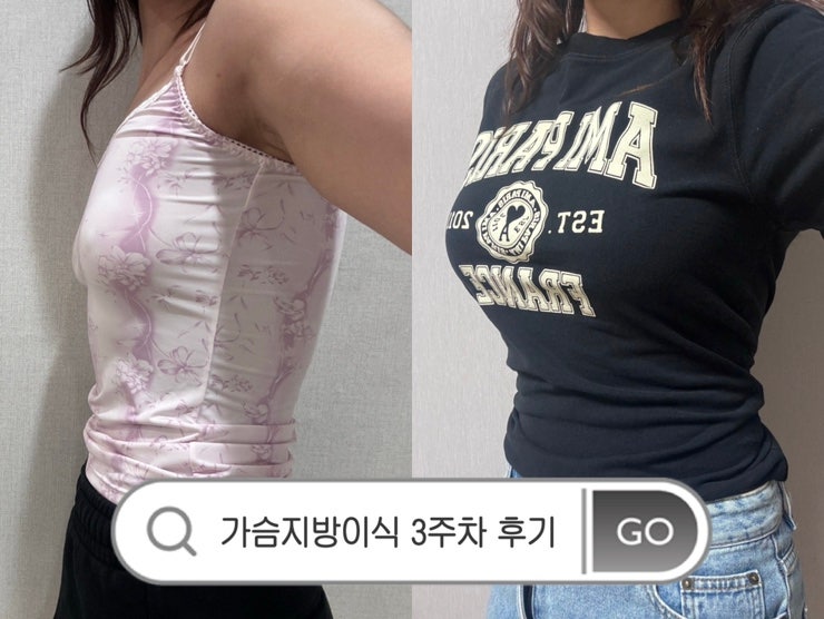 허벅지 지방흡입 + 가슴 지방이식 3주차 후기, 가격 공유!