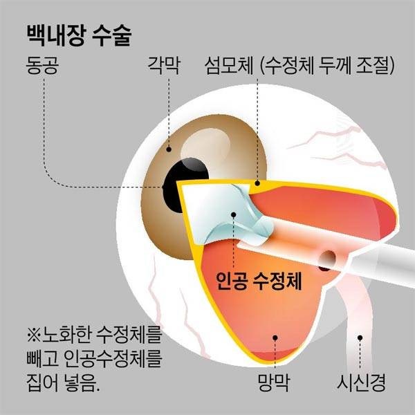 백내장수술비용 2026년 건강보험 적용 기준 총정리