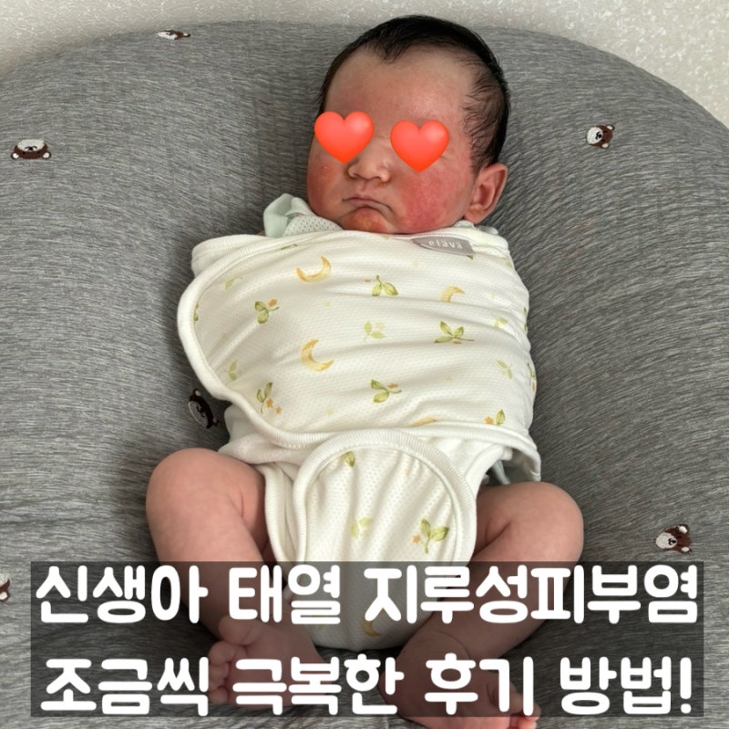 신생아 심한 피부 트러블 태열, 지루성 두피염, 홈케어로 서서히 극복한 방법 총정리!