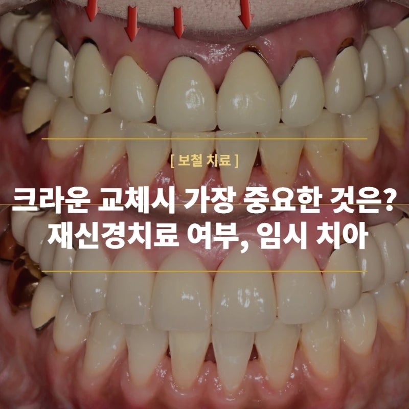 앞니 크라운 교체 크라운 교체보다 중요한 것이 있다고? 재신경치료, 임시 치아