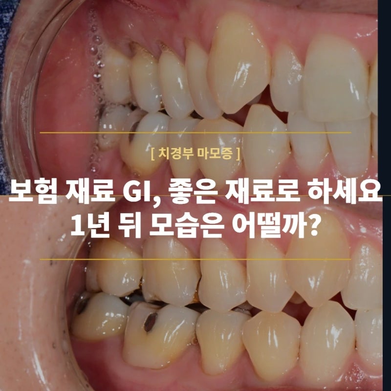 치경부 마모증 GI 치료는 좋은 재료로 하세요! 1년 후 상태는 어떠할까?