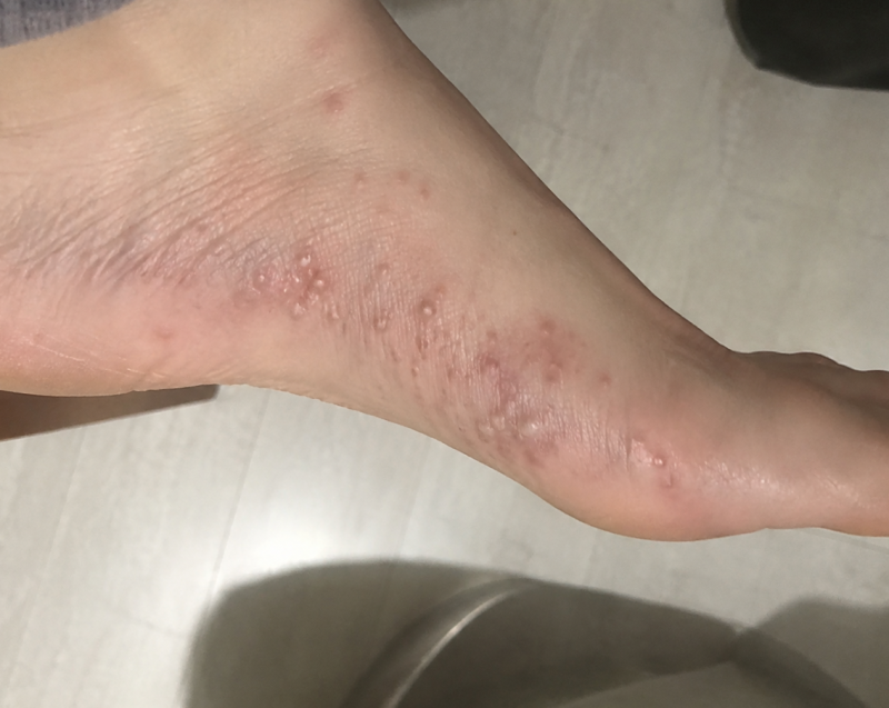 발 한포진 왜 생길까? 물집 대처하는방법