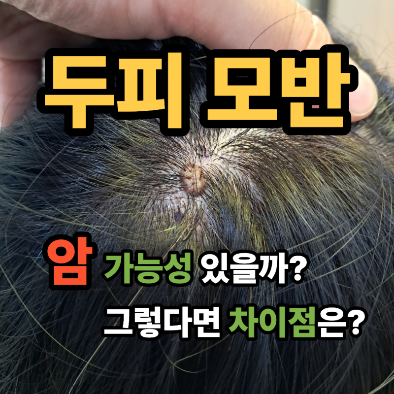 두피모반 암 가능성 있을까? 그렇다면 차이점은?
