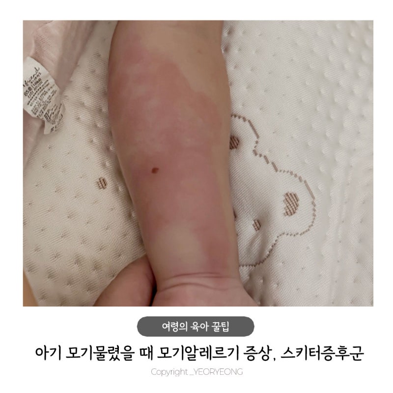 아기 모기물렸을때 이렇게까지 붓는다면? 24개월 아기 모기알레르기 스키터증후군 증상과 치....