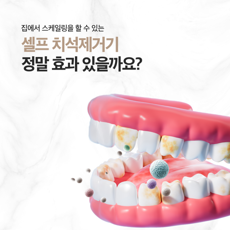화명동치과, 셀프치석제거 괜찮을까요? 셀프스케일링 하기 전 알아두세요