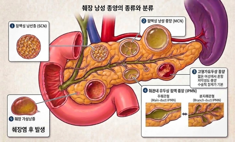 건강검진에서 “췌장에 물혹이 있어요”라는 말을 들으셨나요? — 췌장낭성종양 완벽 정리