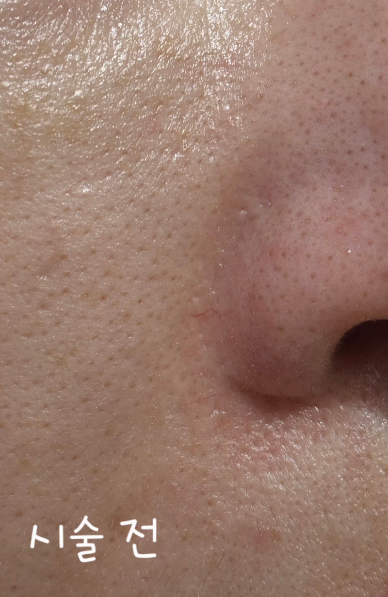 (내 돈 내산)코 옆 실핏줄,코 주변 붉은기 엑셀V 레이저 후기!(통증부터 7일 차 경과까지)