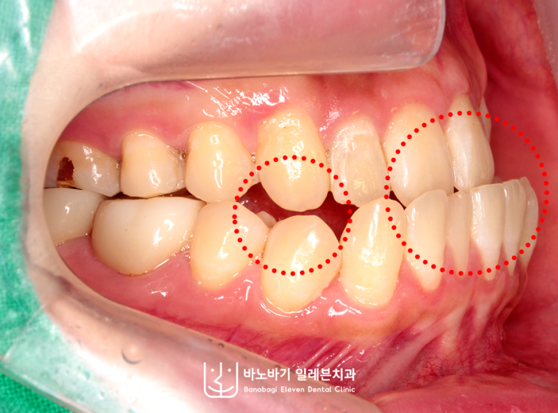 코티코토미 주걱턱 치아교정이 무엇인가요?