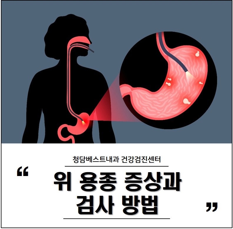 위 용종도 증상이 있나요? 검사 방법과 종류별 꼭 제거해야 하는 경우