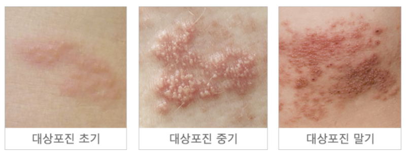 대상포진에 좋은 음식 찾다가 알았다 음식보다 먼저 챙길 게 있었다