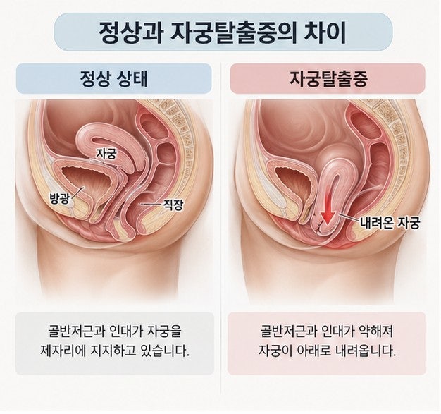 자궁탈출증 증상, 원인, 치료, 자궁이 빠지는 느낌, 케겔운동, 페서리, 수술 등 총정리