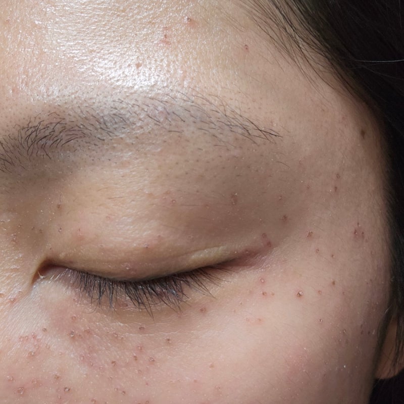 부천 편평사마귀 무한제거 솔직후기 - 눈가에 편사 많은 분, 듀오덤 귀찮은 분들 추천!! (+일....
