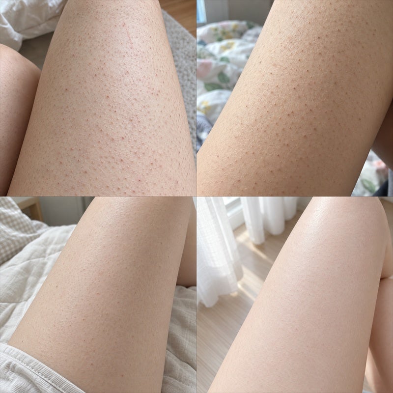 모공각화증 치료 비용과 관리 방법 3가지 및 실사용 후기 공유합니다