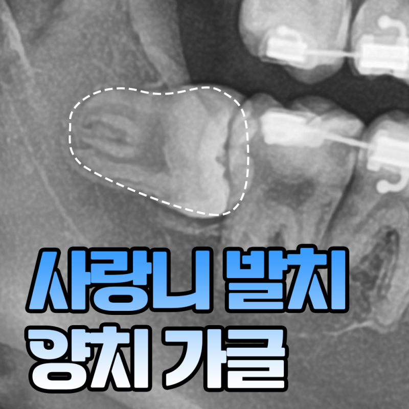 사랑니발치 후 당일 양치 가글 해도 될까?