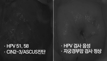 자궁경부이형성증 증상 없다고 안심하면 안 되는 이유