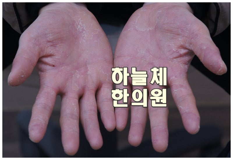 대전 한포진과 주부습진, 같아 보여도 원인과 관리방법은 다릅니다