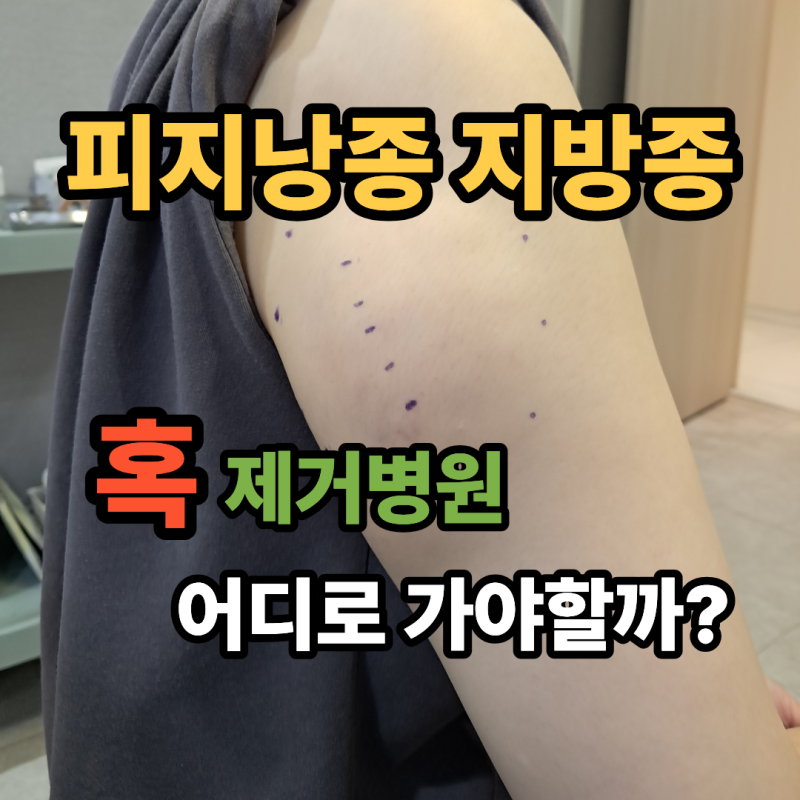 강동구 피지낭종 지방종 혹 제거병원 어디로 가야할까?
