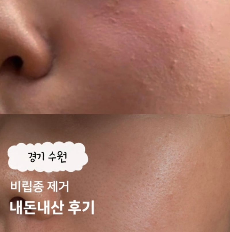 수원 비립종 제거 내돈내산 후기: 무제한 가격 비교부터 듀오덤 재생 크림 추천까지
