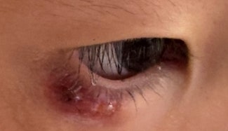 아기 눈다래끼 5개월 결국 눈다래끼 째기 했어요 4살 아기 일산 ㅇㅇ안과 후기
