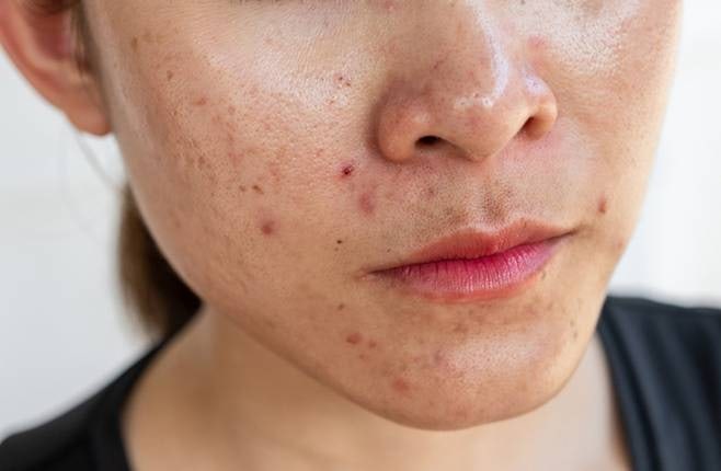 지성·트러블 피부 필수! 논코메도제닉 화장품 뜻과 제품 고르는 팁