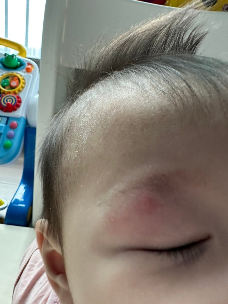 아기 모기 물렸을때 대처법과 가려움 진정에 도움주는 연고 고민된다면