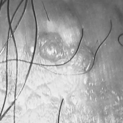 곤지름 HPV 감염 초기증상 요도, 항문 돌기와 통증, 치료는 어떻게?