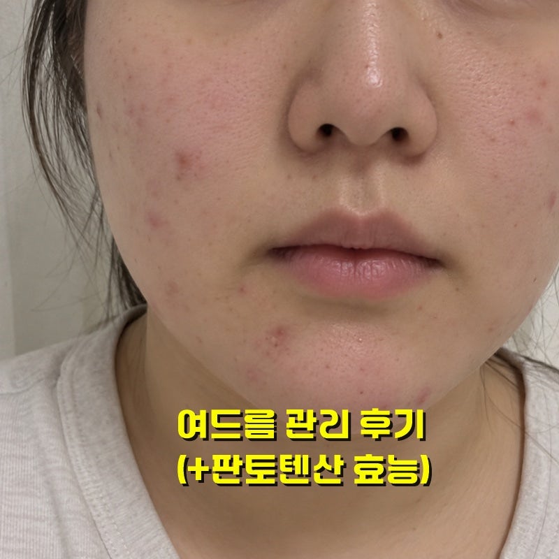 판토텐산 여드름 논문분석 직접 먹어봄