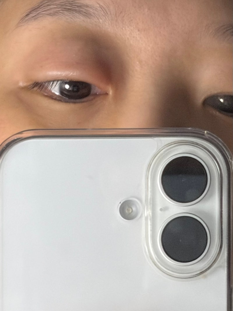 임산부 다래끼 약처방, 관리 방법