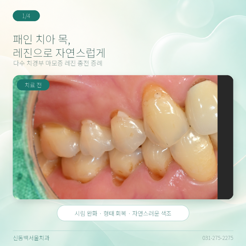 치경부 마모증 레진 수복 치료