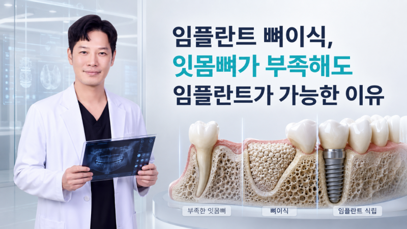 임플란트 뼈이식, 잇몸뼈 부족과 상악동거상술까지 발치 즉시 임플란트로 회복하는 방법
