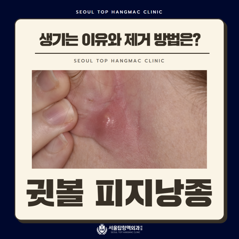 귓볼 피지낭종이 자주 생기는 이유와 제거 방법은