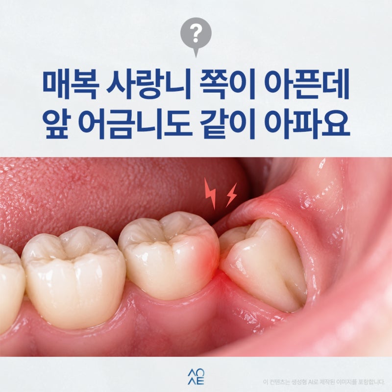 매복사랑니 통증 주위염 때문에 그럴 수도 있을까요?