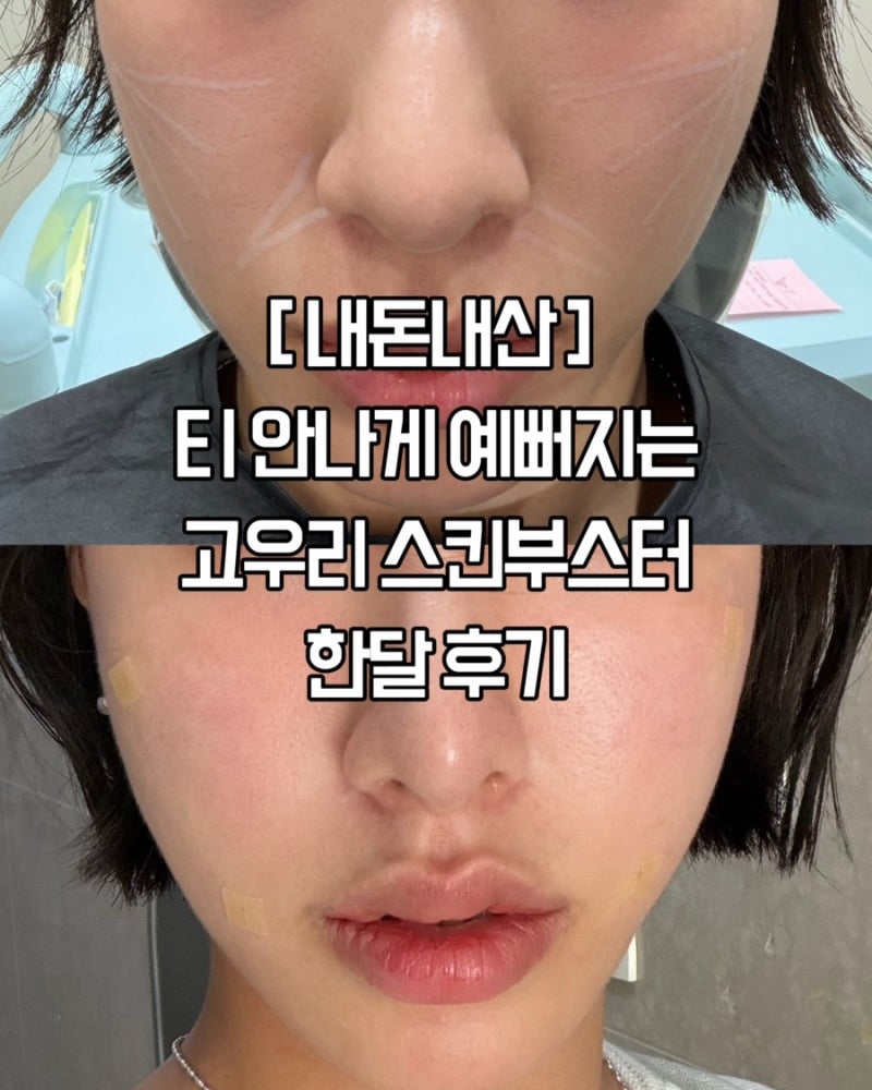 [광주] 다들 몰래 하는 이유가 있었네? 상무지구 피부과 고우리 스킨 부스터 내돈내산 찐 후....