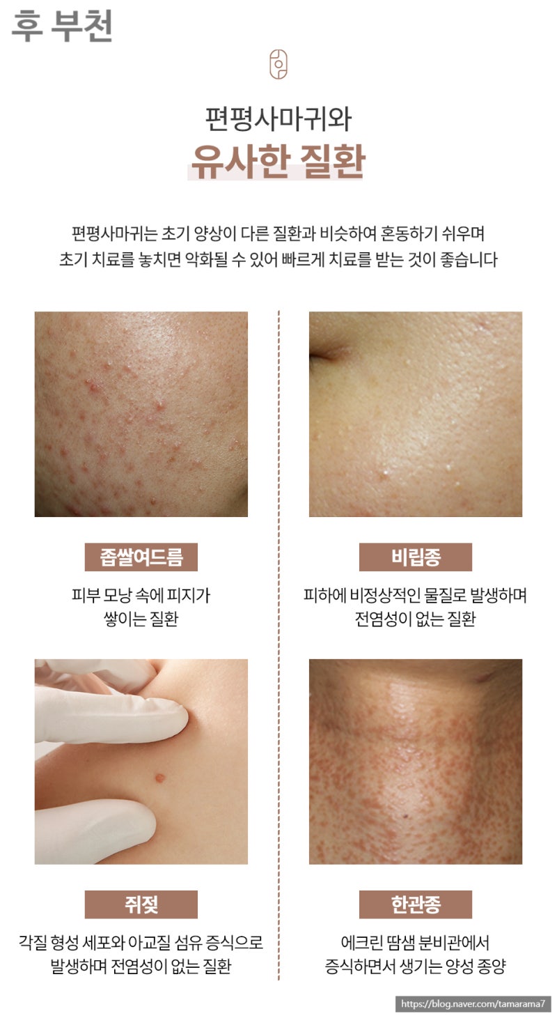 [송내/상동] 편평사마귀 무제한 제거 이벤트, 편사 제거 성지 후한의원 부천점