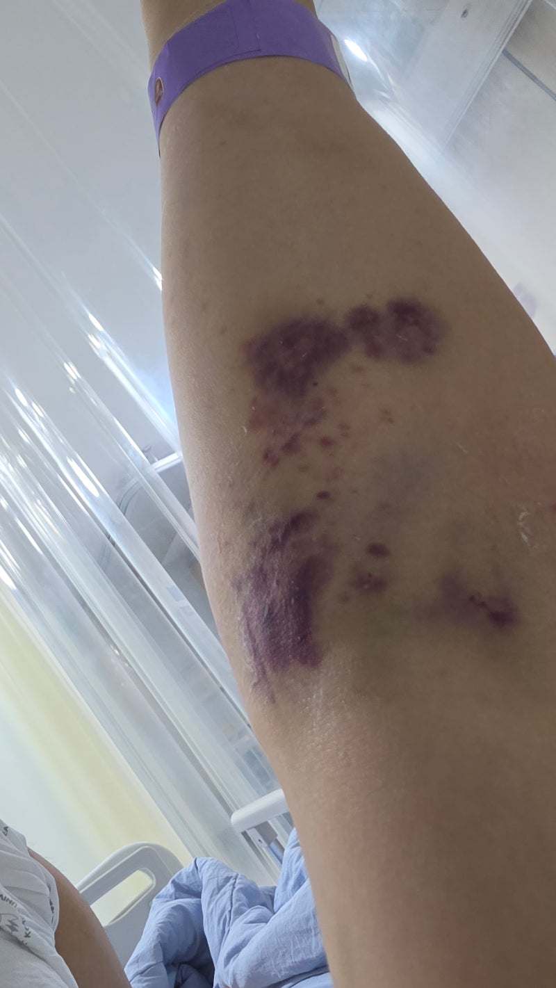 백혈병 투병일기(2) 1일차 입원~1주차 골수검사 통증 후기, 만성 골수성 백혈병 급성 림프구성....
