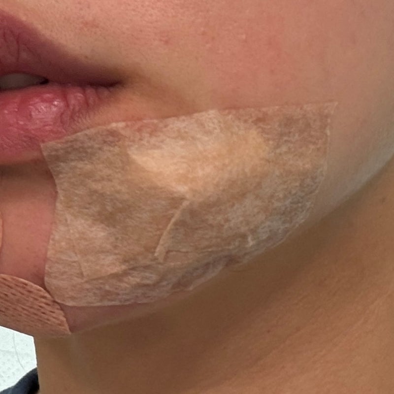 얼굴 피지낭종 제거 수술 후기｜가격·실비 청구는? 당일 통증부터 3일차까지