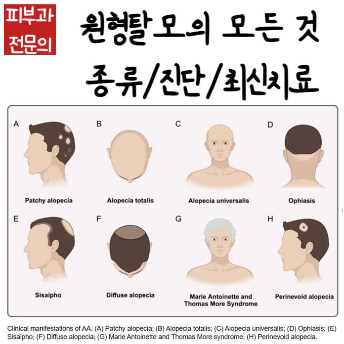 원형탈모(Alopecia areata) 논문기반 최신지견 : 종류/진단/스테로이드주사/먹는약/바르는약/엑시....