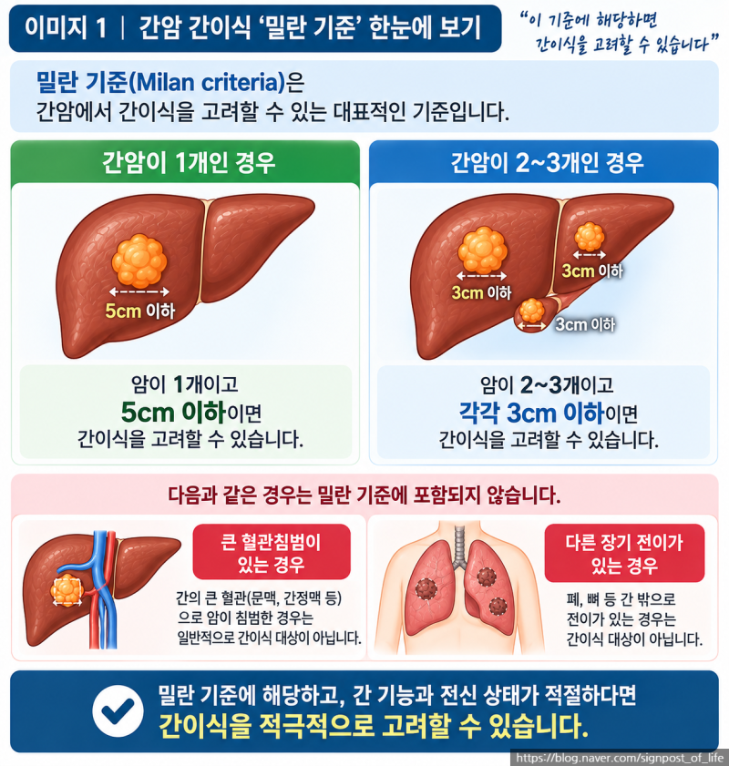 간암 간이식 몇 cm까지 가능할까?5cm·3개 기준 쉽게 정리｜간암 시리즈 7편
