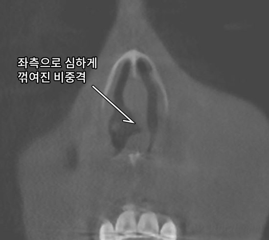 비중격만곡증성형외과 비염 있을때 고려해봐야 하는 것