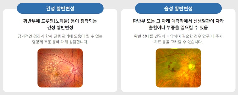 [용인 처인구안과 서울새봄안과] 황반변성 치료?? 수술하면 좋아지나요??