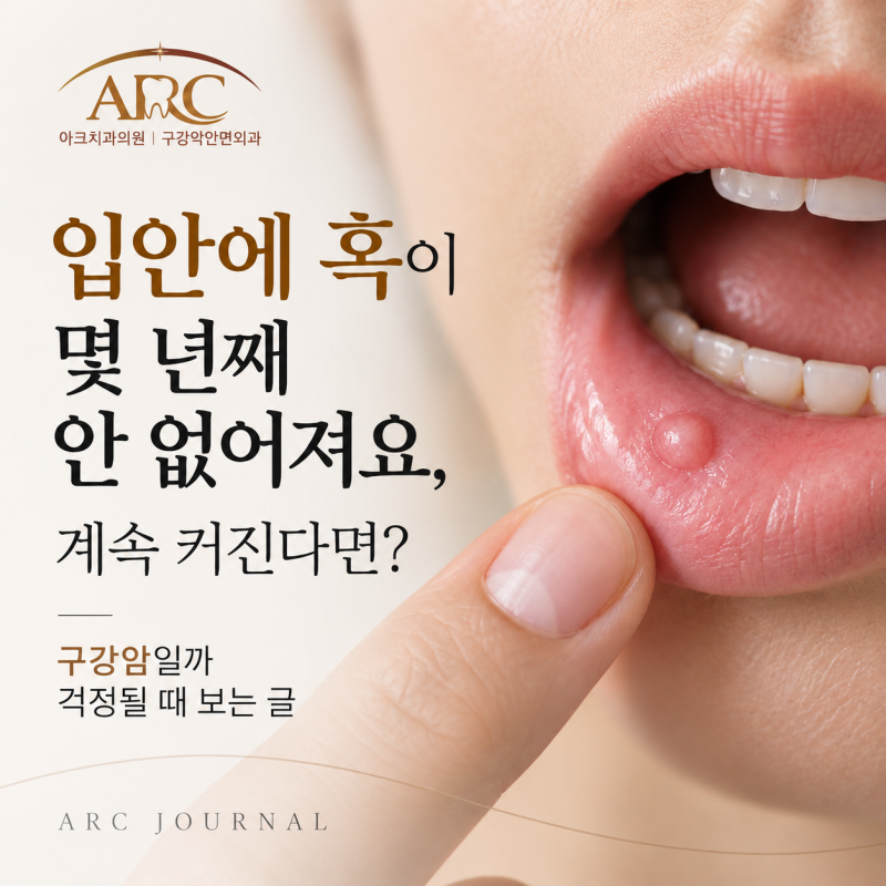 입안에 혹이 몇 년째 안 없어져요, 계속 커진다면? 구강암일까 걱정될 때 보는 글