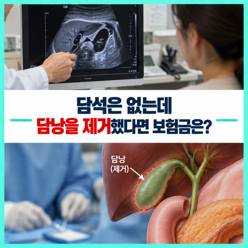 건강검진에서 담낭용종 발견, 담석은 없는데 담낭을 제거했다면 보험금은?