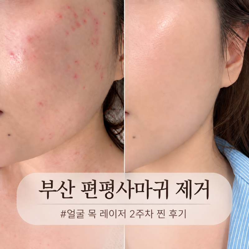 부산 서면 편평사마귀 제거 성지 찐 후기, 얼굴 목 레이저 2주차