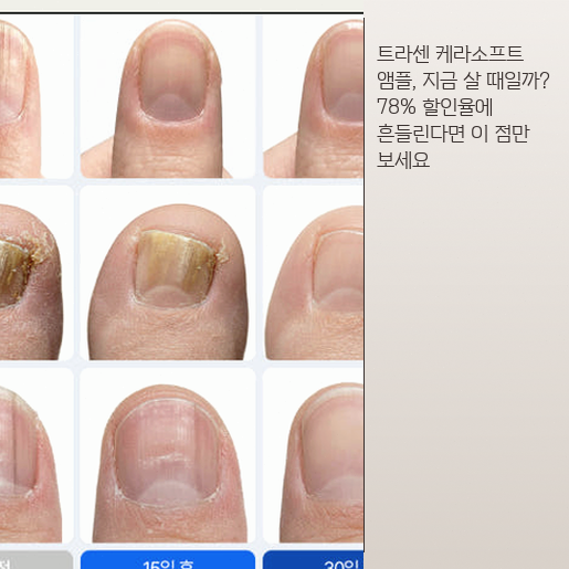 울퉁불퉁 손발톱 영양제, 트라센 케라소프트 써야 할까