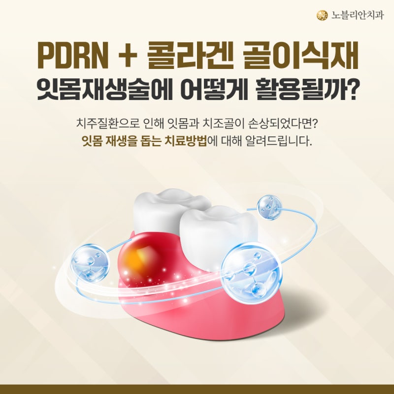 잇몸 내려앉음과 어금니 잇몸 패임, PDRN주사와 콜라겐 골이식재 병행 시기는?